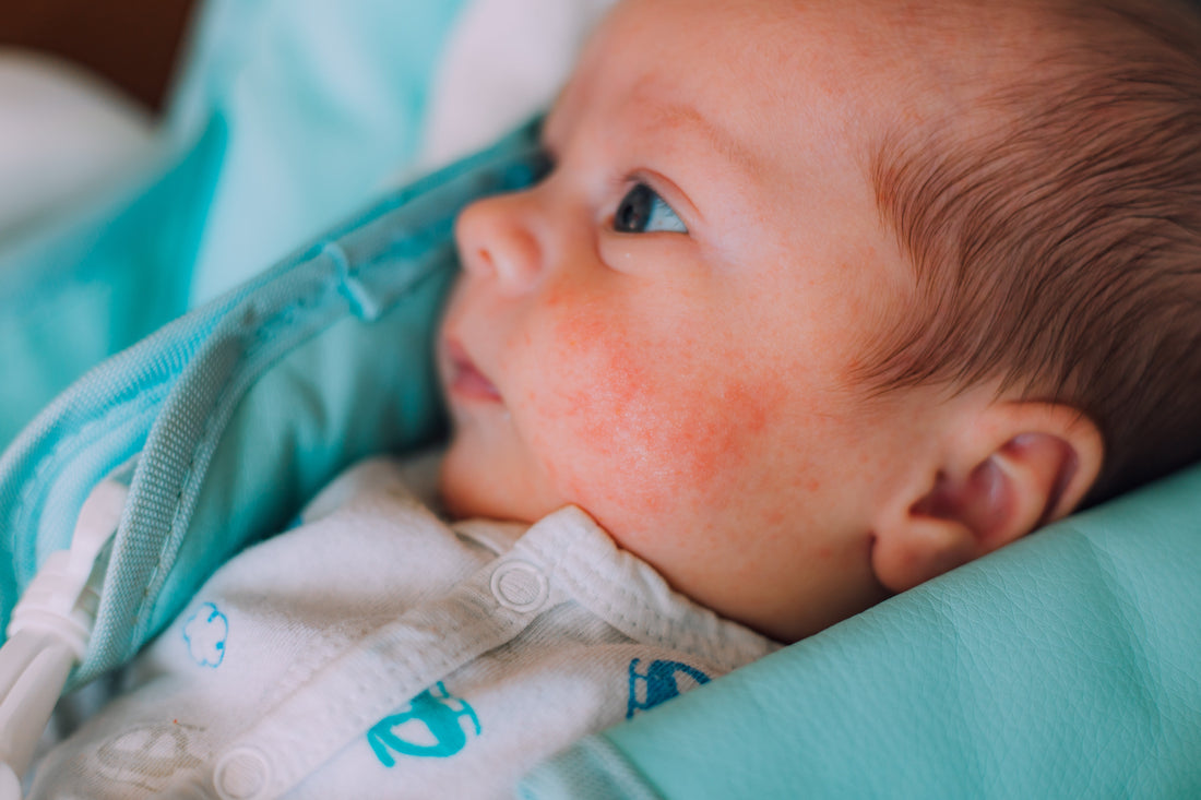 Eczema Season in Kids: Gentle, Effective Care for Sensitive Skin