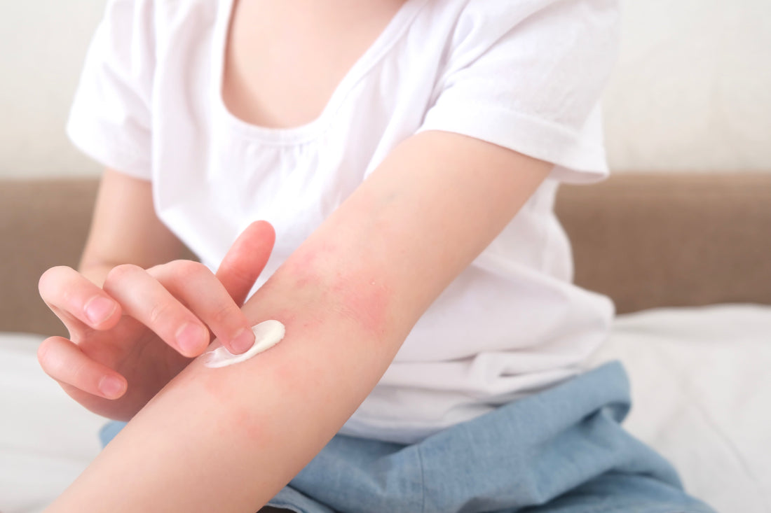 Spring Skin Flare-Ups in Kids: Eczema, Dryness & What Parents Miss