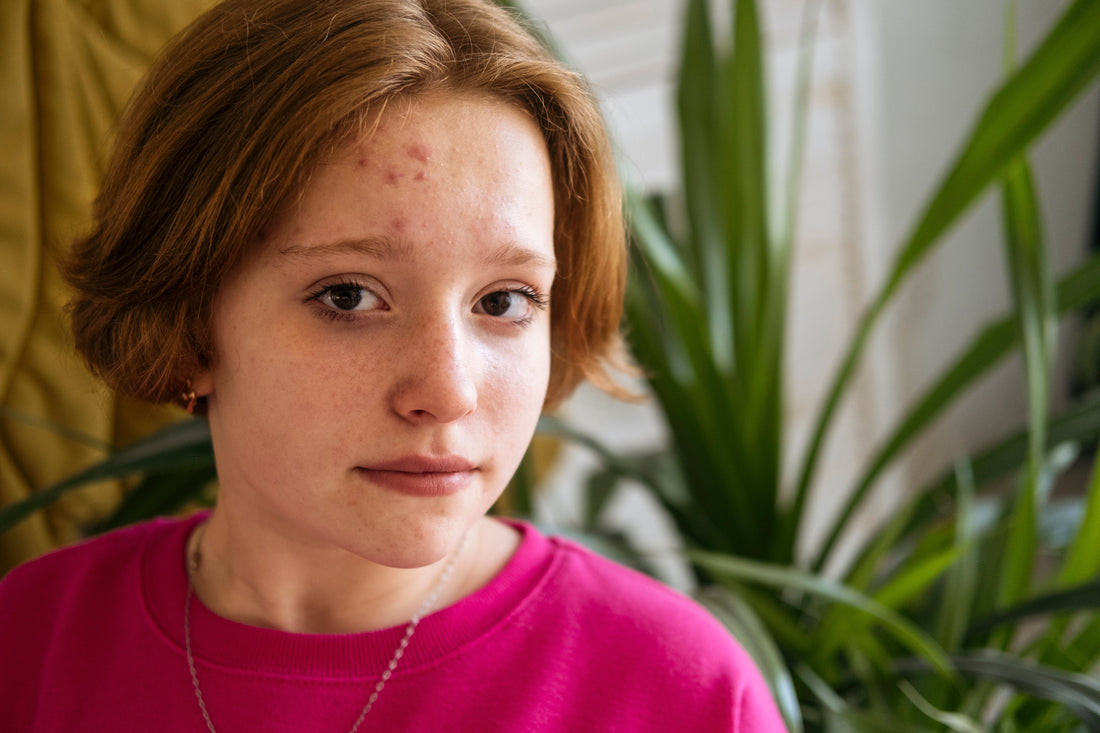 Back-to-School Stress Breakouts: Why Adult Acne Spikes This Time of Year