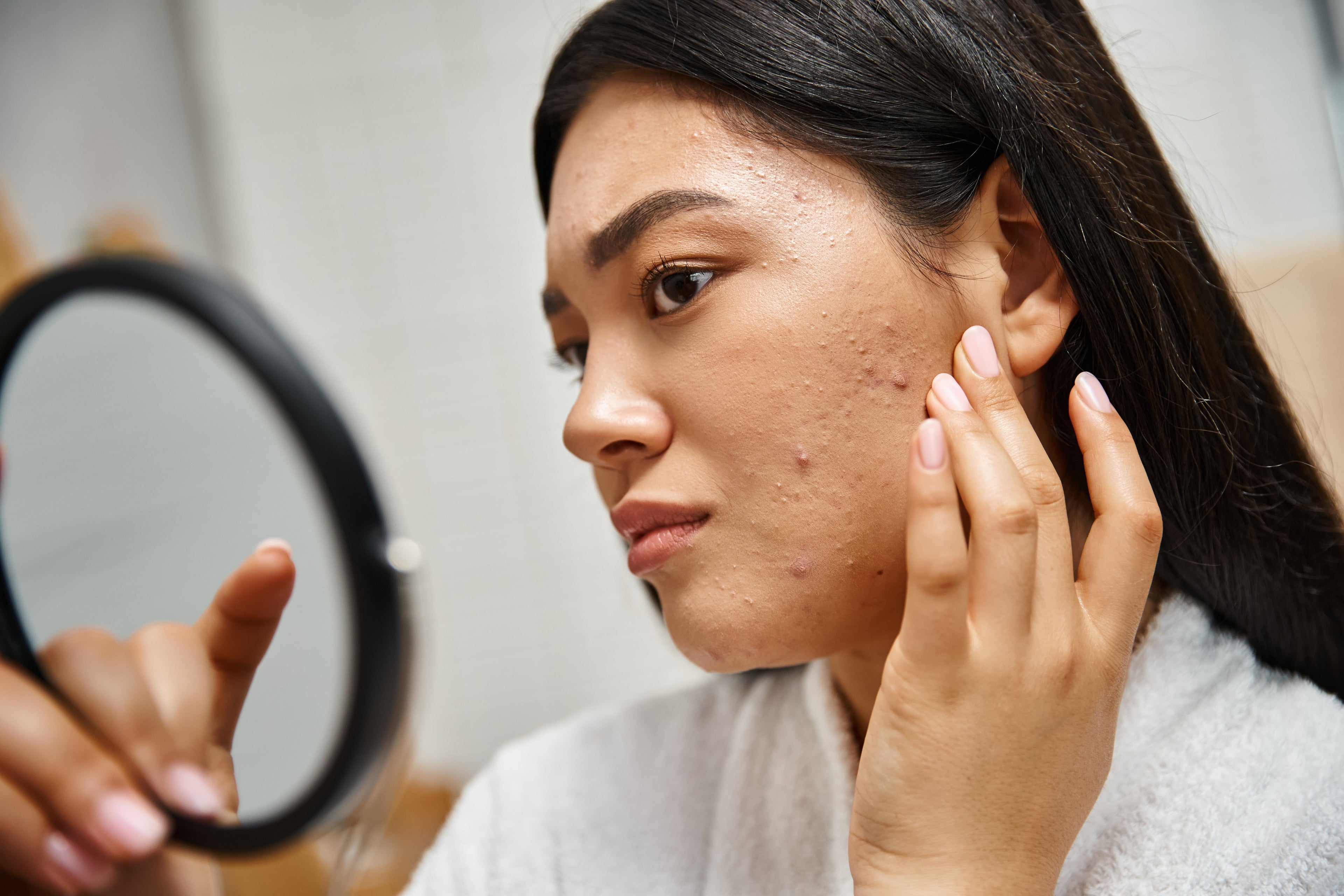 Adult Acne Isn’t Teen Acne: Why Your Skincare Needs to Change
